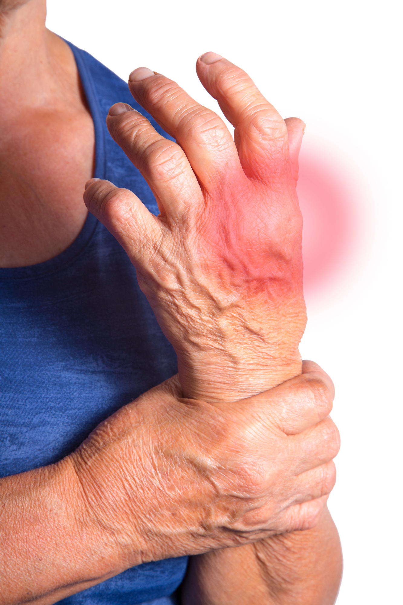 Revmatoidni artritis je precej zakomplicirana zadeva